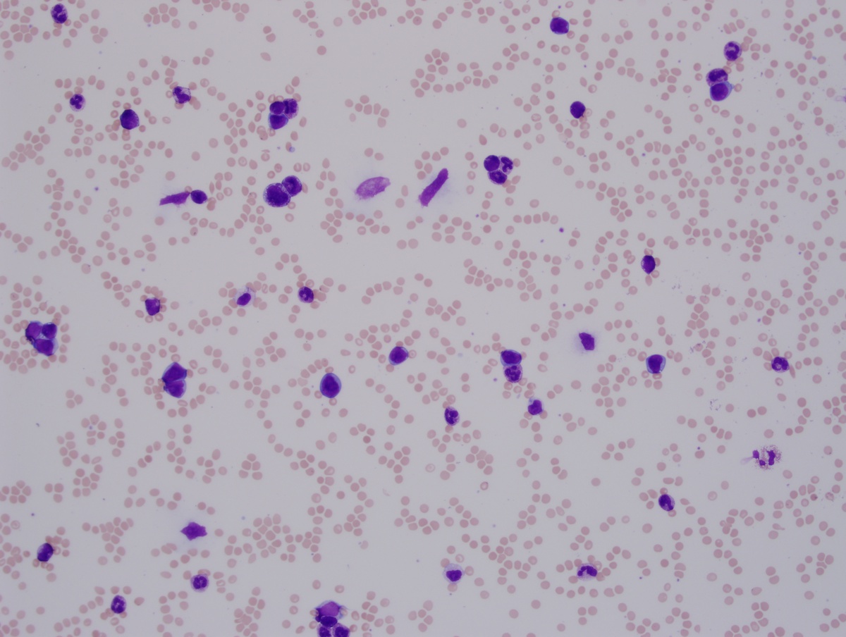 BM biopsy 2 peripheral blood 20x
